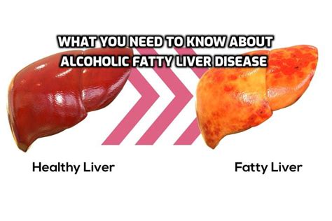 Is CLA hard on the liver?